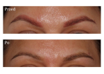 Usuwanie makijażu permanentnego laserem | Klinika Zakrzewscy